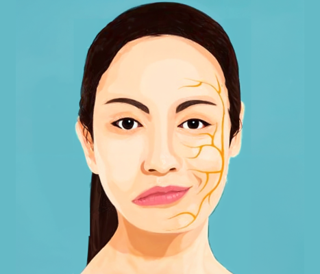 botox-3